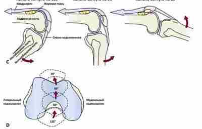 Смещение надколенника Неправильное положение надколенника — это поступательное или вращательное отклонение надколенника по любой…