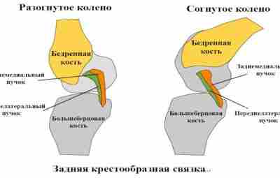 Консервативное лечение повреждений задней крестообразной связки Задняя крестообразная связка (ЗКС) – крупная связка, которая…