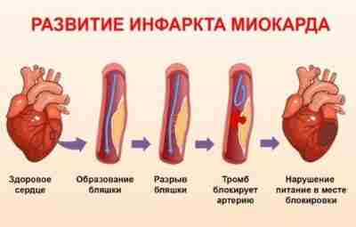 Миф об инфаркте Жирная еда вредна. Считается, чтобы снизить уровень холестерина в крови, нужно…