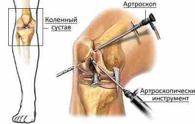 Потенциальный вред артроскопии при лечении болей и дисфункции коленного сустава, вызванных дегенеративными процессами, превышает…
