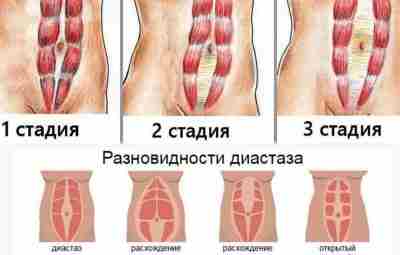 ДИАСТАЗ ПРЯМЫХ МЫШЦ ЖИВОТА. ЛФК ПРИ ДИАСТАЗЕ. Диастаз прямых мышц живота — это расхождение…