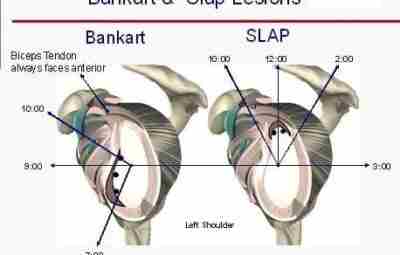 SLAP – синдром плечевого сустава SLAP – синдром (Superior Labrum Anterior to Posterior) –…