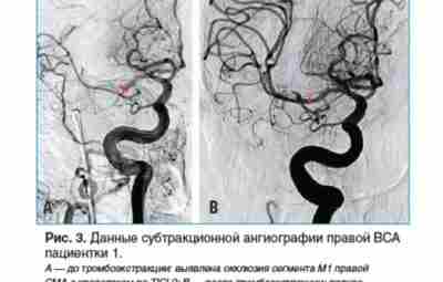 Эндоваскулярная тромбэктомия (удаление тромба из просвета сосуда) при большом ишемическом инсульте: результаты мета-анализа. Рубрика:…