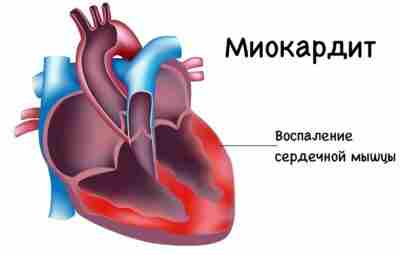 Поствакцинальный миокардит вызвал меньше осложнений по сравнению с постковидным миокардитом Лучше вакцинироваться, чем невакцинироваться….