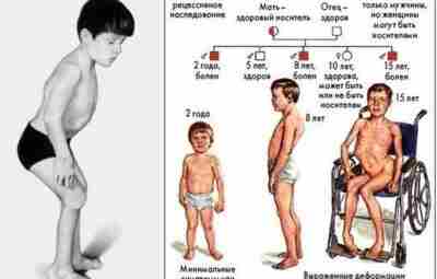 Шкала для скрининга мышечной дистрофии Дюшенна 🧒 У пациентов без семейного анамнеза мышечная дистрофия…