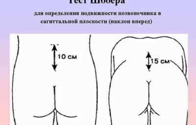 Тест Шобера Тест Шобера используется для определения уменьшения амплитуды сгибания поясничного отдела позвоночника, что…