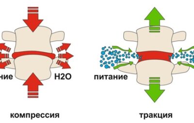 ВЛИЯНИЕ РЕАБИЛИТАЦИИ НА ЗДОРОВЬЕ МЕЖПОЗВОНКОВОГО ДИСКА. Межпозвонковые диски – это важные анатомические структуры, которые…
