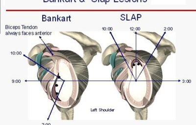 SLAP – синдром плечевого сустава SLAP – синдром (Superior Labrum Anterior to Posterior) –…
