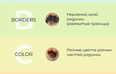 МЕЛАНОМА Об этом коварном заболевании рассказывает врач-онколог сервиса Docma Мифтахутдинова Милла Илдусовна [club206565684| -…