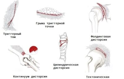 ЧТО НЕОБХОДИМО ЗНАТЬ МАССАЖИСТУ О ФАСЦИИ Фасция имеет большое физиологическое значение в биомеханике и…