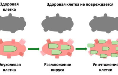 Меланома: эффективность добавления онколитического вируса RP1 к ниволумабу после прогрессирования…