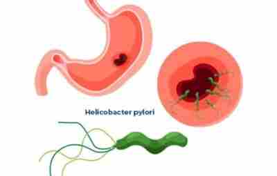 Лечение инфекции Helicobacter pylori снижает в будущем риск развития рака желудка и смерти от…