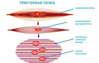 МАНУАЛЬНОЕ ЛЕЧЕНИЕ ТРИГГЕРНОГО ПУНКТА. Триггерный пункт (точка) — триггерная зона, триггерная область (англ. trigger…