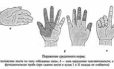 Повреждения срединного нерва Основным клиническим признаком повреждения срединного нерва в области кисти является выраженное…