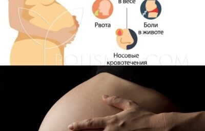 HELLP-синдром — тяжелое осложнение беременности, для которого характерна триада признаков: гемолиз, повреждение печеночной паренхимы…