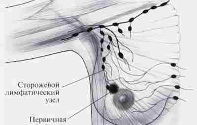 При раке молочной железы в большинстве случаев радикальный подход с удалением лимфоузлов не оправдан…