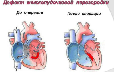 Врожденный дефект сердца, при котором в межжелудочковой перегородке образуется отверстие. В результате этого происходит…