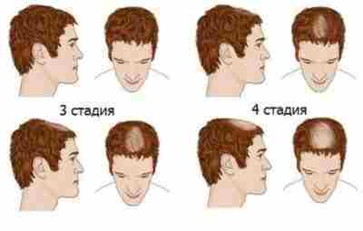 Андрогенная алопеция Чаще всего андрогенной алопецией страдают мужчины — это состояние также известно как…