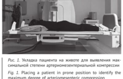 Синдром верхней брыжеечной артерии: «Считаю, что в этом случае было три слагаемых успеха диагностики.»…