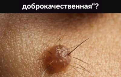 Опасный миф, распространённый среди врачей (онкологов и дерматологов): «Волосы растущие из родинки — являются…