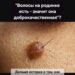 Опасный миф, распространённый среди врачей (онкологов и дерматологов): «Волосы растущие из родинки — являются…
